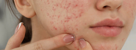 Stress acne: What is it & how to get rid of it