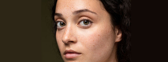 How Does Acne Lead To Hyperpigmentation