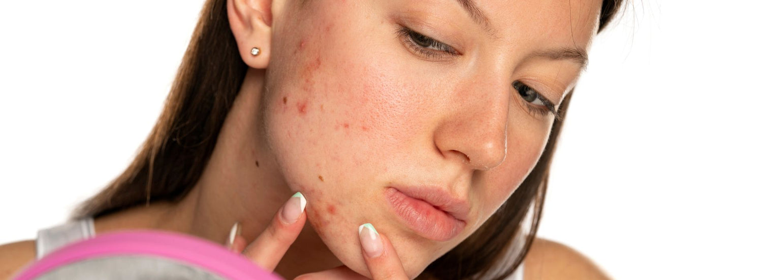 Role Of Comedogenic Products In Causing Acne: Better Alternatives Explored